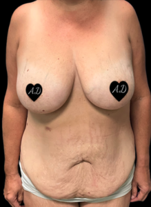 Abdominoplasty